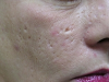 acne5