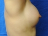 breast_implant_after_1-1