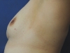 breast_implants_before_2-1