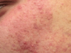 acne1