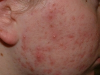 acne3