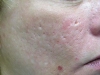 acne6