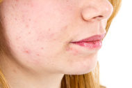 acne scar_3